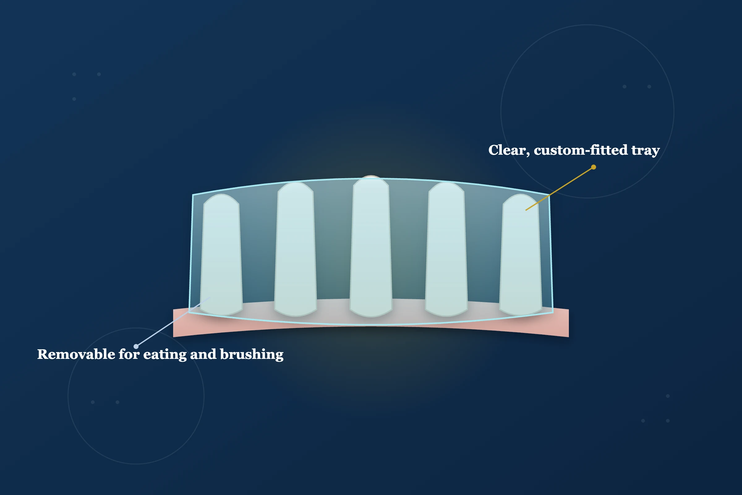 Clear Aligners at Clarus Dental Specialities, Koregaon Park, Pune
