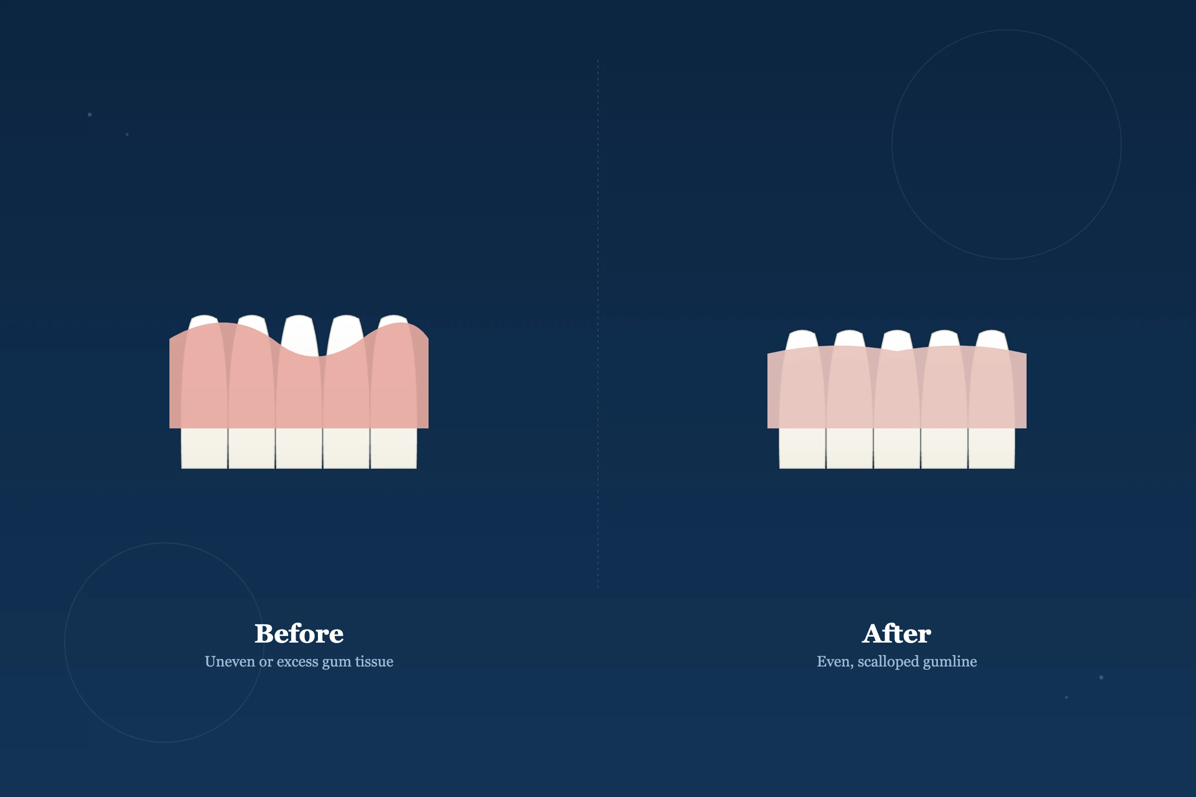 Gum Contouring at Clarus Dental Specialities, Koregaon Park, Pune