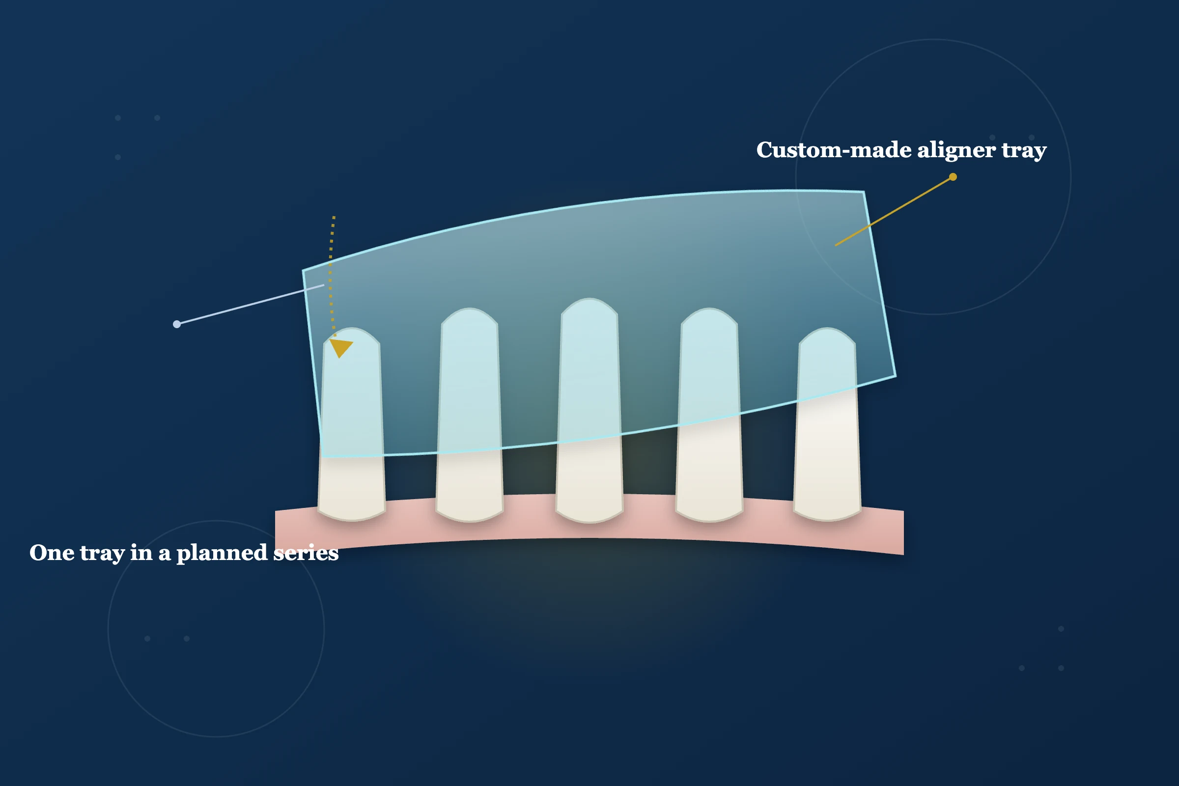 Invisalign at Clarus Dental Specialities, Koregaon Park, Pune