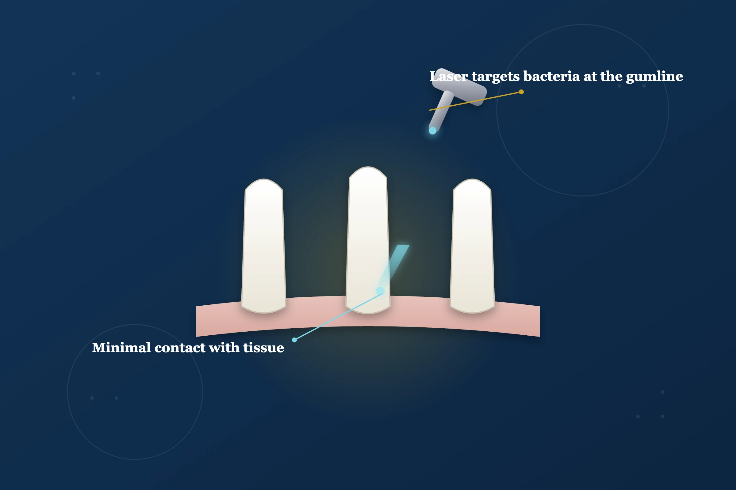 Laser Gum Treatment at Clarus Dental Specialities, Koregaon Park, Pune
