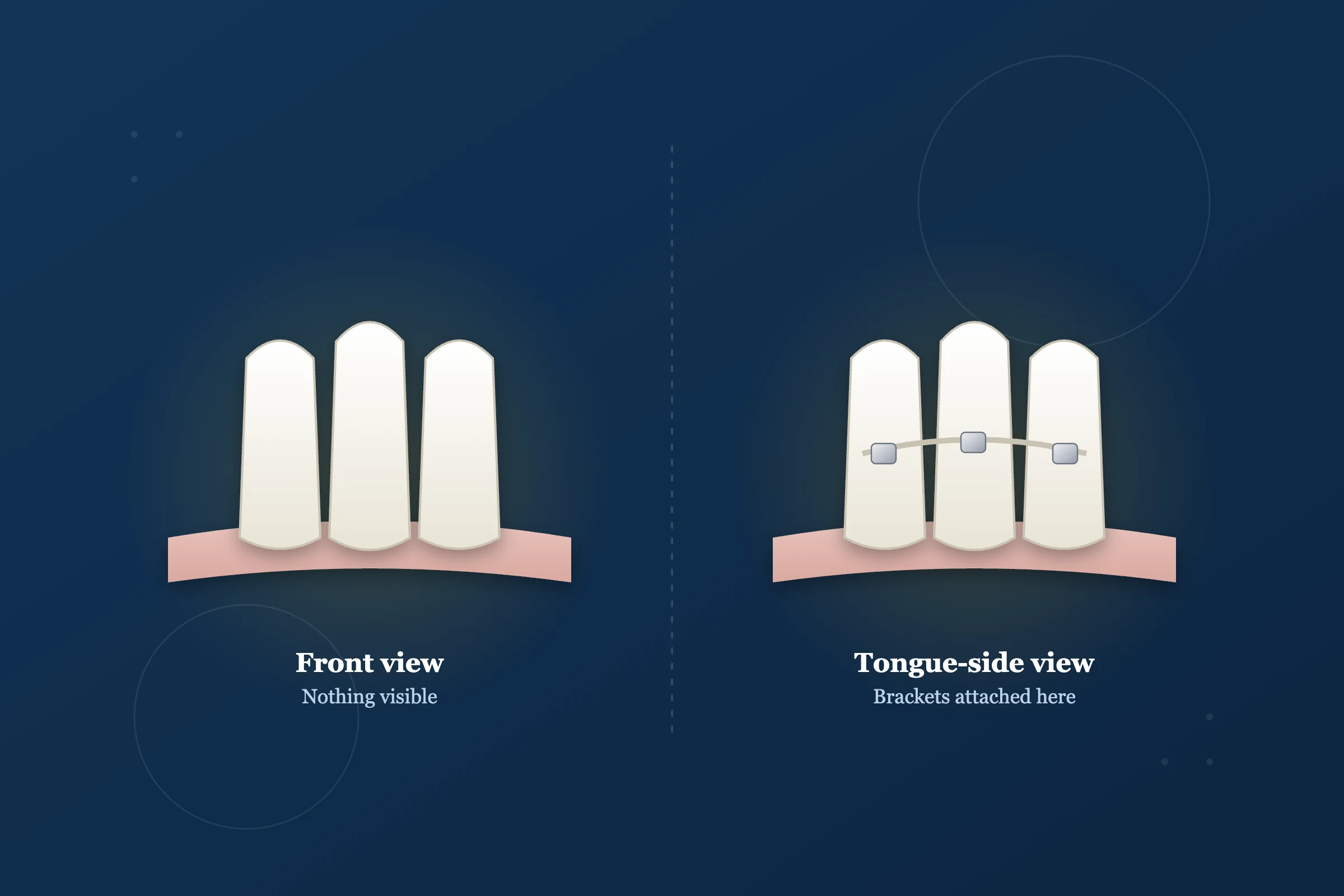 Lingual Braces at Clarus Dental Specialities, Koregaon Park, Pune