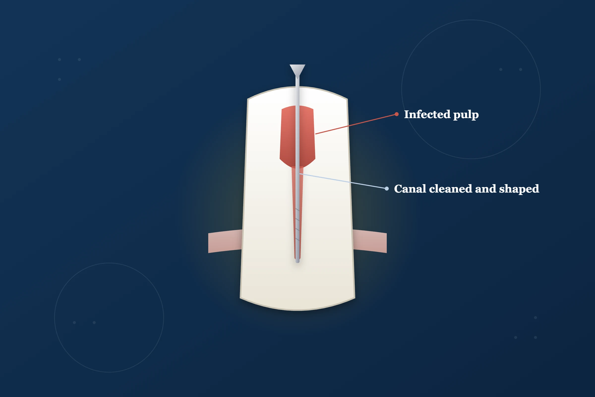 Root Canal Treatment at Clarus Dental Specialities, Koregaon Park, Pune