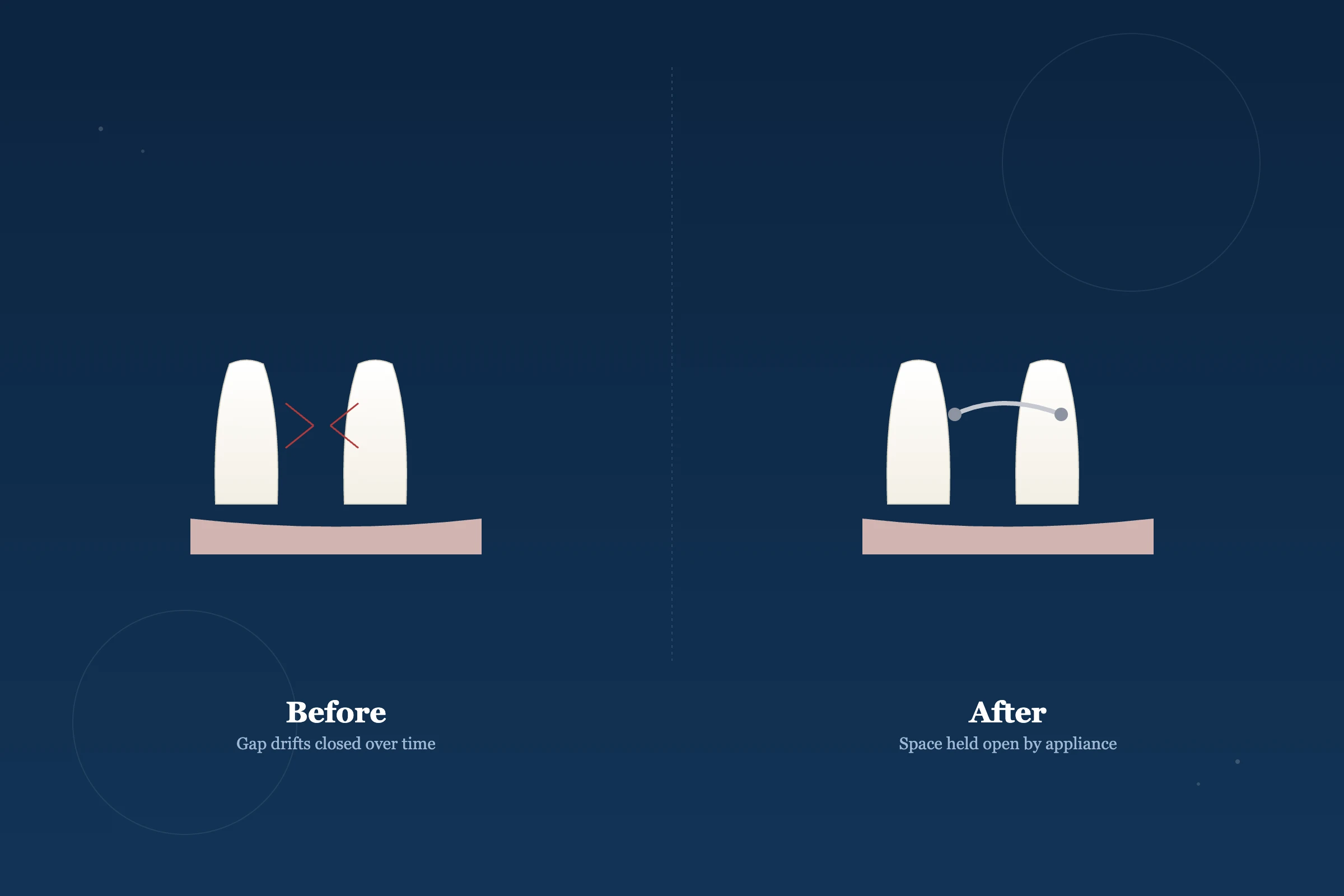Space Maintainers at Clarus Dental Specialities, Koregaon Park, Pune