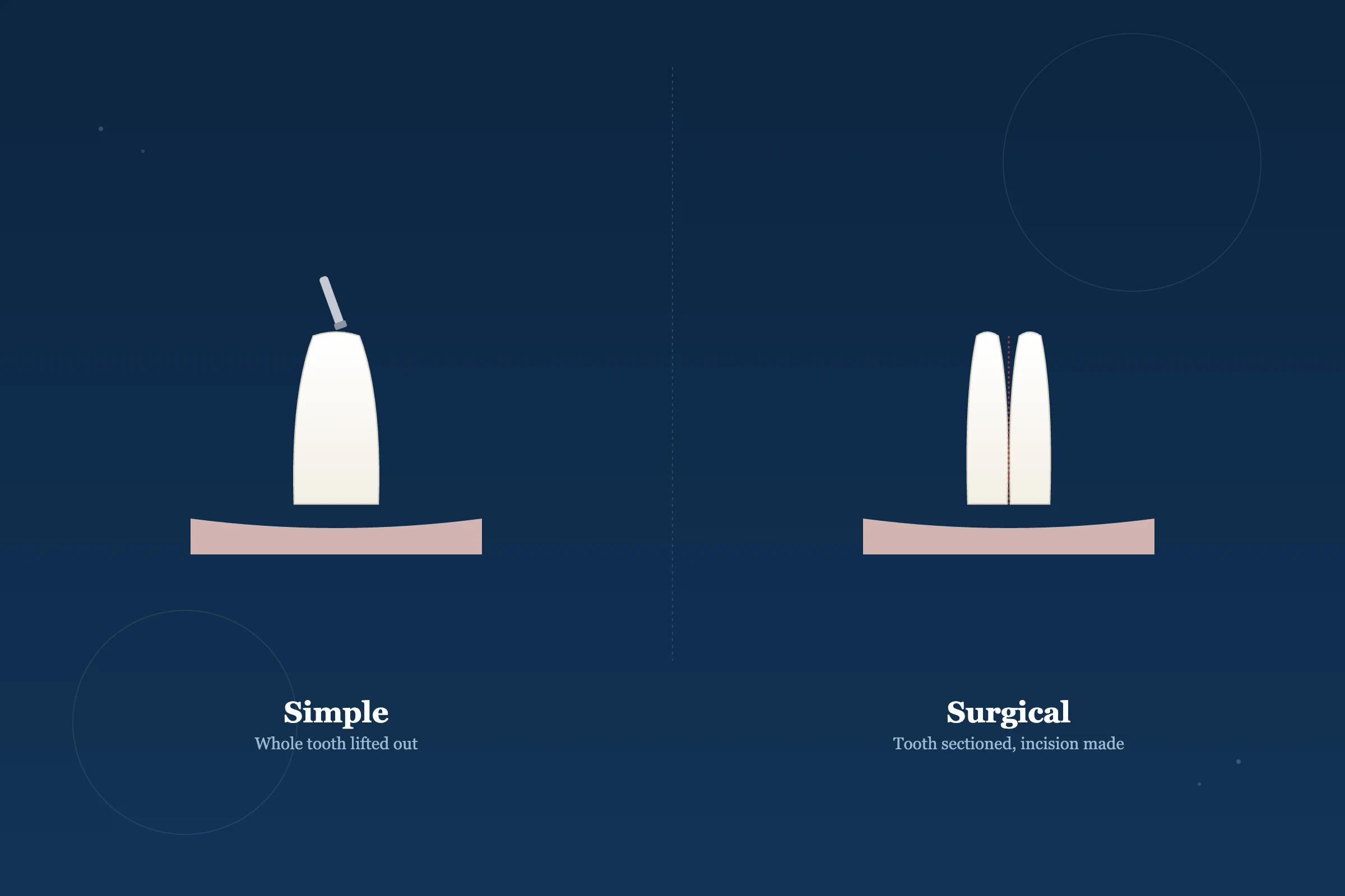 Surgical Tooth Extraction at Clarus Dental Specialities, Koregaon Park, Pune