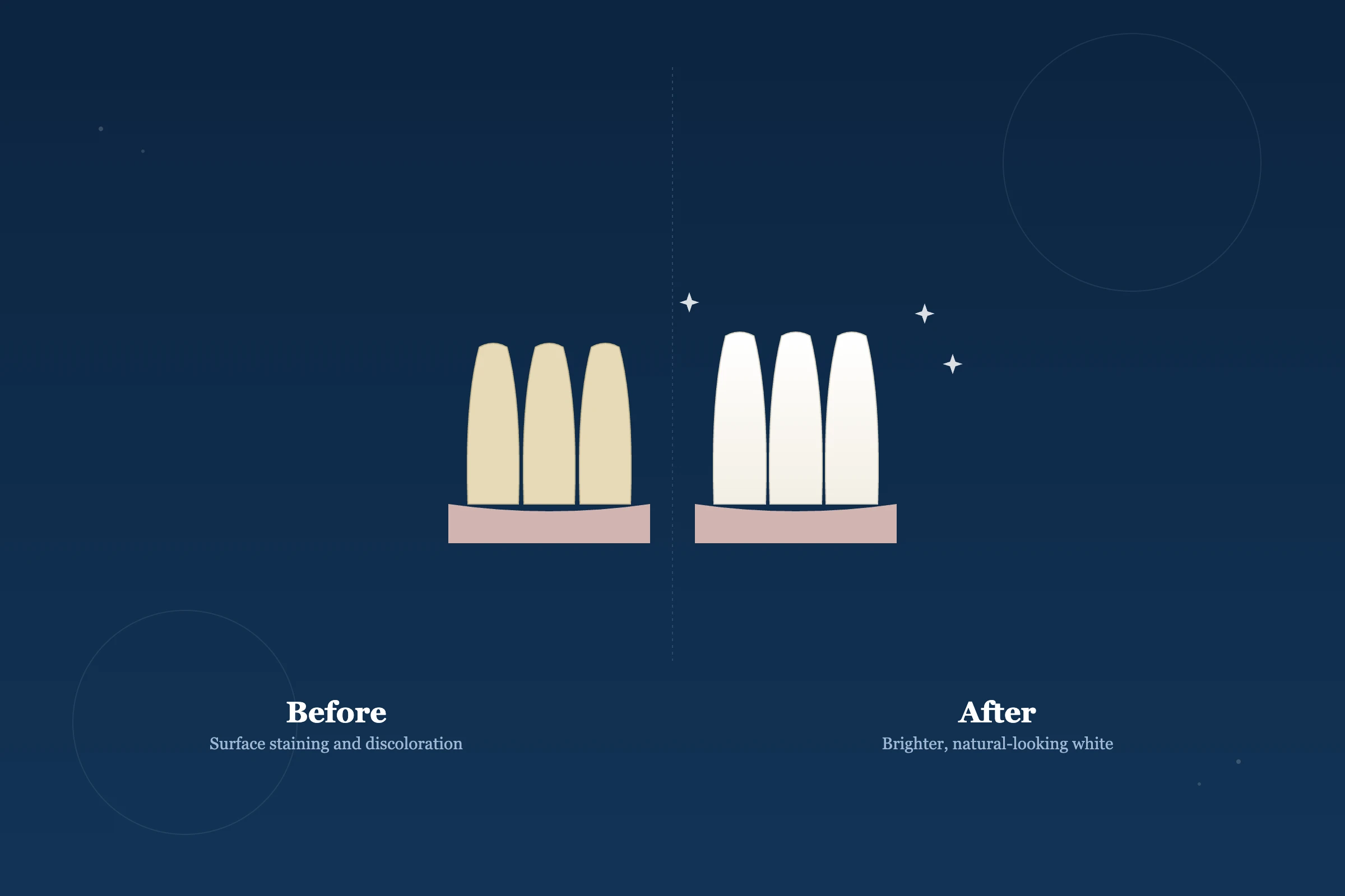 Teeth Whitening at Clarus Dental Specialities, Koregaon Park, Pune