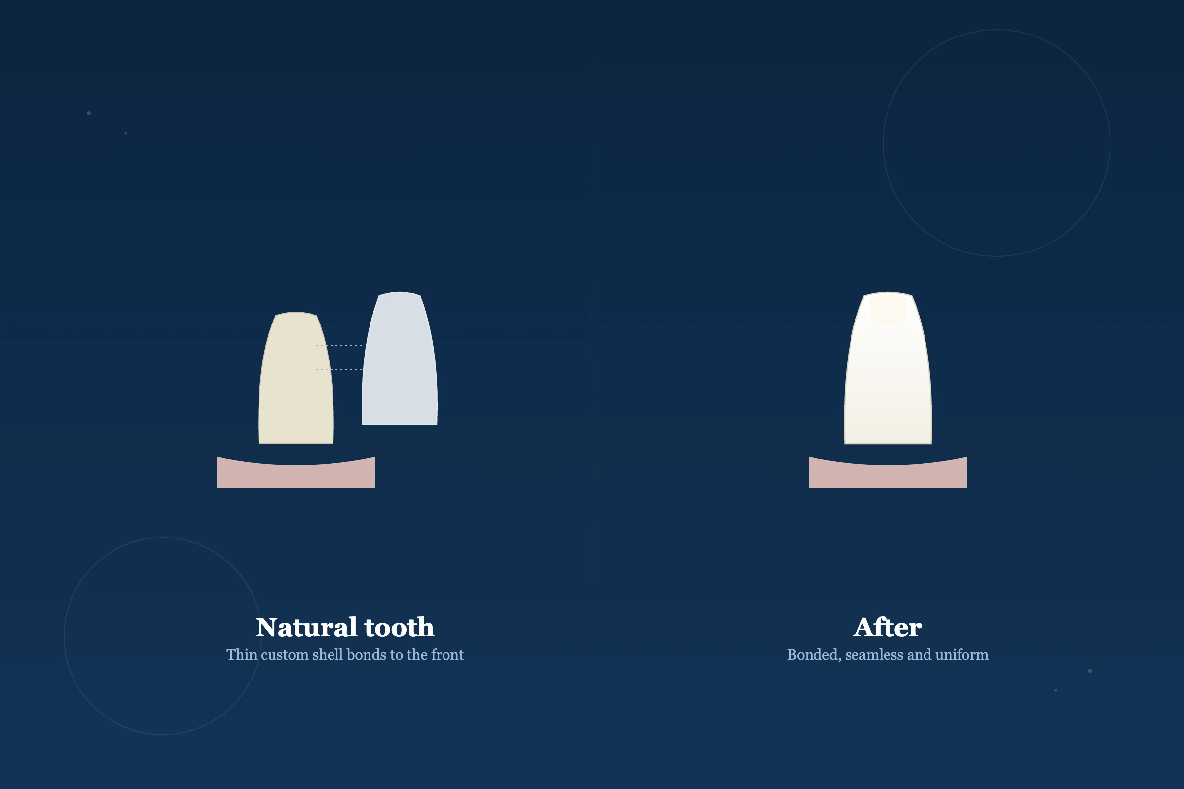 Veneers at Clarus Dental Specialities, Koregaon Park, Pune