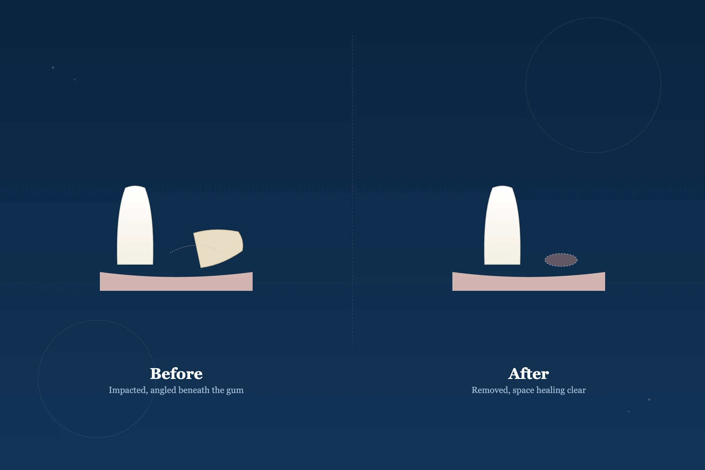 Wisdom Tooth Removal at Clarus Dental Specialities, Koregaon Park, Pune